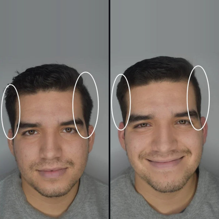 Juan: side hair before and after DPERM